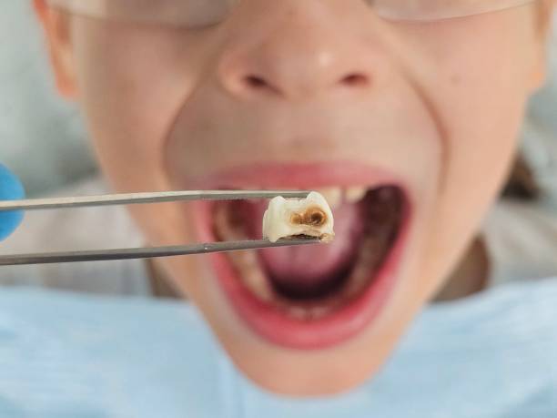 Best Broken or Cracked Tooth Emergency Dentist in USA